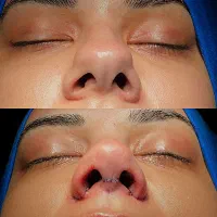 جشنواره جراحی بینی ،با تخفیف ویژه رزرو کن