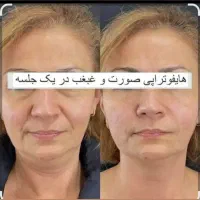 جشنواره هایفو تراپی  لیفت صورت و گردن