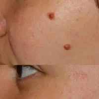 برداشتن خال های گوشتی و انجام تتو بدن و فیبروز|خدمات آرایشگری و زیبایی|ارومیه, |دیوار