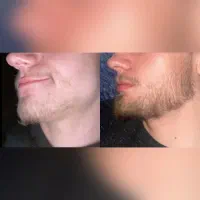 خداحافظی با ریش کم‌پشت