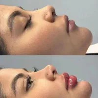 بوتاکس ژل لب گونه چانه فک پر کردن صورت لاغر نخ مزو|خدمات آرایشگری و زیبایی|قم, زنبیل آباد|دیوار