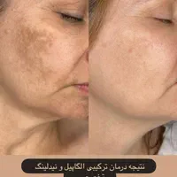 درمان تک جلسه ای تضمینی کک و مک ،لک،اسکار ،جوش|خدمات آرایشگری و زیبایی|قزوین, |دیوار