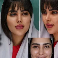 عمل جراحی بینی لیفت خدمات زیبایی با متد پیشرفته