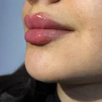 اموزش فیلر لب گونه چونه زاویه خط لبخند