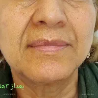 لیفت وجوانسازی قوی صورت|خدمات آرایشگری و زیبایی|رشت, گلسار|دیوار