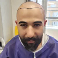 مزوتراپی/درمان ریزش موقطعی|خدمات زیبایی و سلامت|تبریز, |دیوار