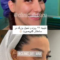 آف ویژه زیبایی بینی و لیپو ابدو|خدمات زیبایی و سلامت|اهواز, کیانپارس |دیوار