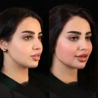 تزریق چربی صورت با ماندگاری ۱۰ ساله - دکتر واحدی