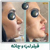 فیلر(ژل) لب گونه چانه خط خنده زاویه توسط پزشک رشت|خدمات آرایشگری و زیبایی|رشت, گلسار|دیوار