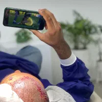 کاشت موی طبیعی با بیشترین تراکم و مناسب ‌ترین قیمت