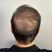 اسکالپ تکنیک نوین پرپشتی مو،جایگزین کاشت مو|خدمات آرایشگری و زیبایی|مشهد, وکیل‌آباد|دیوار