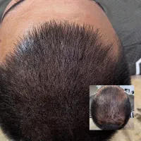 میکرواسکالپ اسکراپ کاشتمو درمجموعه زیبانو|خدمات آرایشگری و زیبایی|مشهد, گوهرشاد|دیوار