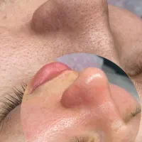 فیشیال و پاکسازی پوست تحت نظر پزشک در کلینیک