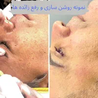 برداشتن خال/زگیل/منگوله های پوستی**|خدمات آرایشگری و زیبایی|اصفهان, مرداویج|دیوار