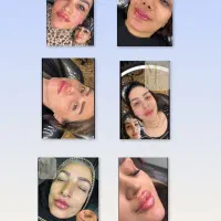 فراخوان ژل لب