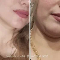 ژل وبوتاکس.برداشتن خال.فیلربینی انزیم پاککردن تاتو|خدمات آرایشگری و زیبایی|مشهد, طبرسی شمالی|دیوار