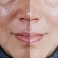 درمان تمام لک ها