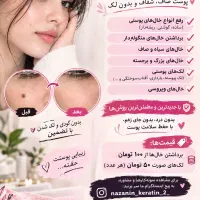 ازبین بردن انواع  لک خال وکک و مک و... در یک جلسه