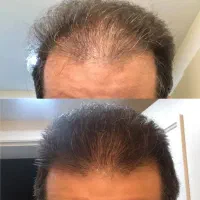 مخصوص کچلا