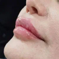 ژل سی سی۵۰۰ پرسینگ، چال گونه|خدمات آرایشگری و زیبایی|اهواز, کمپلو جنوبی|دیوار