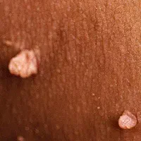 درمان قطعی زگیل و تبخال با ضمانت