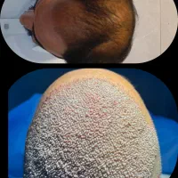 روش جدید بدون جراحی فول تراکم|خدمات آرایشگری و زیبایی|آمل, |دیوار