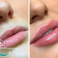 جشنواره ژل لب ، بوتاکس ،نخ لیفت