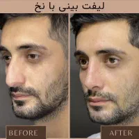 مرکز تخصصی فرم دهی و‌لیفت بینی و صورت با نخ و‌ژل|خدمات آرایشگری و زیبایی|مشهد, احمدآباد|دیوار