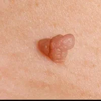 درمانhpvریشه ای زگیل تناسلی زیگیل خال میخچه بواسیر|خدمات آرایشگری و زیبایی|تهران, تهرانپارس غربی|دیوار