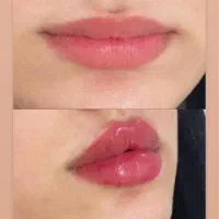 فیلر لب ۱/۶۰۰/تاپایان این هفته|خدمات آرایشگری و زیبایی|رشت, کوی حسینی|دیوار