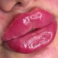 تزریق ژل و بوتاکس|خدمات آرایشگری و زیبایی|اردبیل, |دیوار