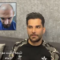 کاشت مو با خط رویش طبیعی ، فقط ۱۶ میلیون