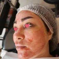 آموزش مزو نیدلینگ +تکنیک پوست کره ای+کاموفلاژ بدن|خدمات آموزشی|مشهد, هنرستان|دیوار