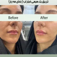 تزریق فیلر زیر چشم