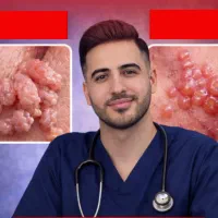 درمان زگیل با کادر درمان IRAN HPV