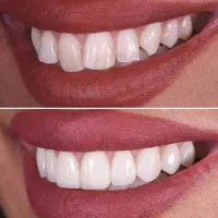 مهمترین عنصر زیبایی صورت ظاهر دندانهاست|خدمات آرایشگری و زیبایی|عنبرآباد, |دیوار