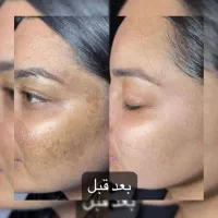 کرم سفیدکننده(آنتی استاین) ترکیب آمپولی|آرایشی، بهداشتی، درمانی|بم, |دیوار