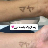 بلفاروپلاستی، پاک کردن تتو، ژل لب، وایتنینگ پوست|خدمات آرایشگری و زیبایی|باقرشهر, |دیوار