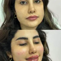 تزریقات ژل وبوتاکس