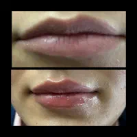 تخفیف ویژه فیلر فقط۵۹۹بوتاکس فقط۶۹۹|خدمات آرایشگری و زیبایی|محمدیه-قزوین, |دیوار