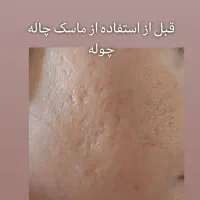 ماسک و کرم چاله چوله و منافذ باز صورت|آرایشی، بهداشتی، درمانی|مشهد, نوید|دیوار