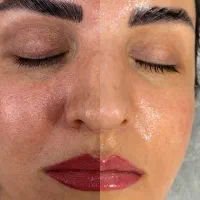 فیشال و(پاکسازی پوست)آبرسانی پوست|خدمات آرایشگری و زیبایی|رفسنجان, |دیوار