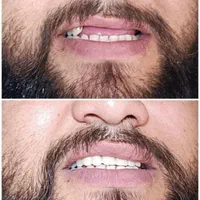 دندان دندانسازی پروتز با چک|خدمات آرایشگری و زیبایی|مشهد, موعود|دیوار
