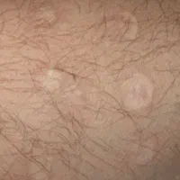 راهنمایی رفع اثر سوختگی