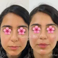 تزریق ژل و بوتاکس|خدمات آرایشگری و زیبایی|بابل, |دیوار