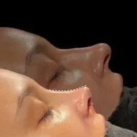 جراحی بینی / جشنواره ویژه کلینیک آرمیس