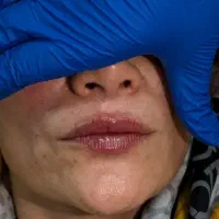 جشنواره تخفیف تزریق ژل لب و فیلرر مزو جوانساز|خدمات زیبایی و سلامت|تهران, شهرک ولیعصر شمالی|دیوار