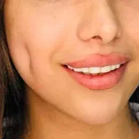 انجام.آموزش چال گونه/پیرسینگ/میکرودرمال برازجان