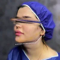 ساکشن غبغب|خدمات آرایشگری و زیبایی|یاسوج, |دیوار