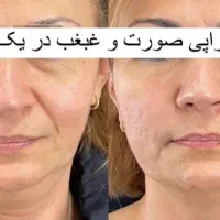 لیزر موهای زائد299هزار، هایفو،سفیدی پوست|خدمات آرایشگری و زیبایی|تبریز, |دیوار